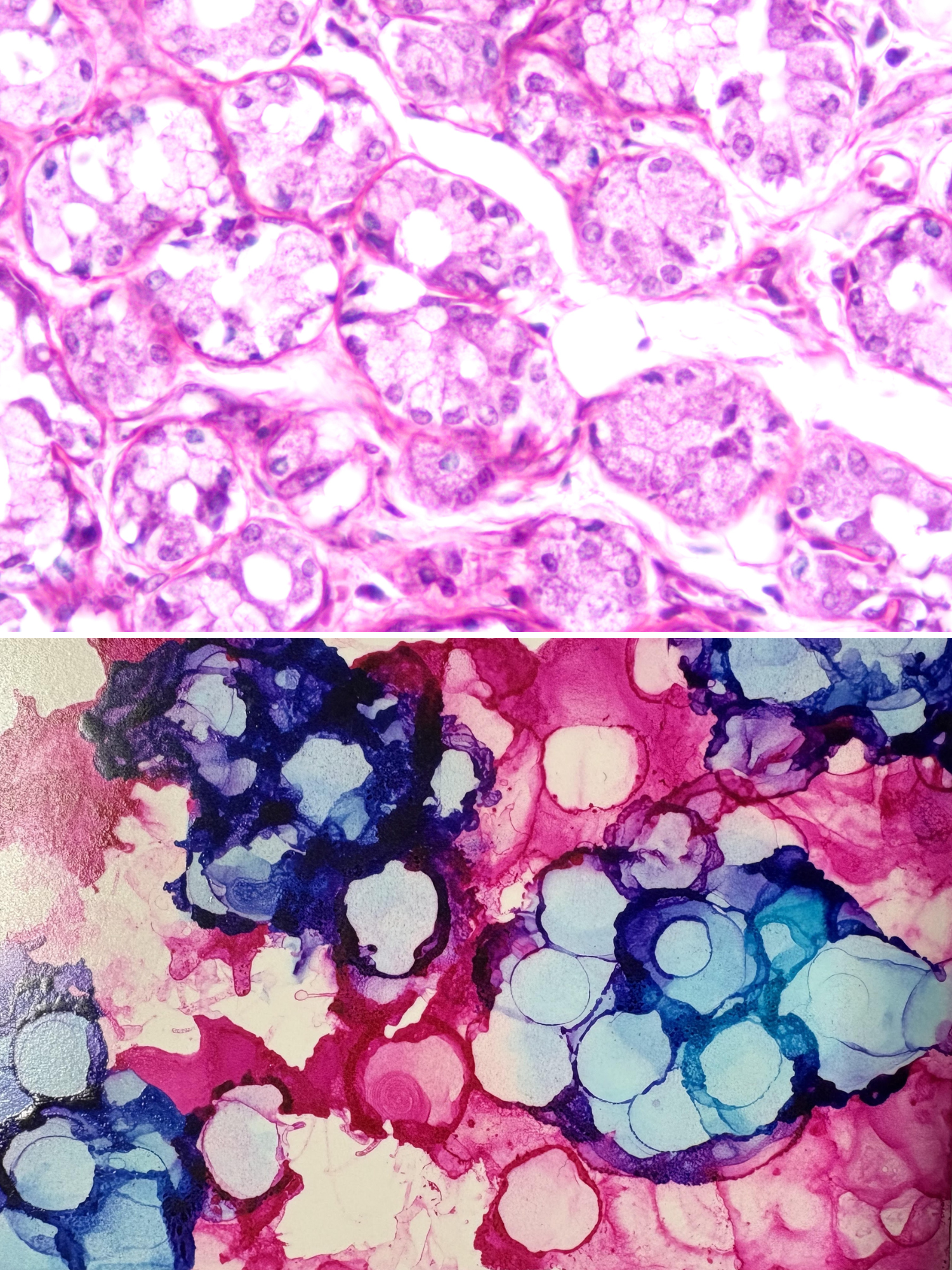 Histology stain of human tissue (on top)  inspired Jayasri “Jay” Narasimhan’s  alcohol ink art (on bottom).